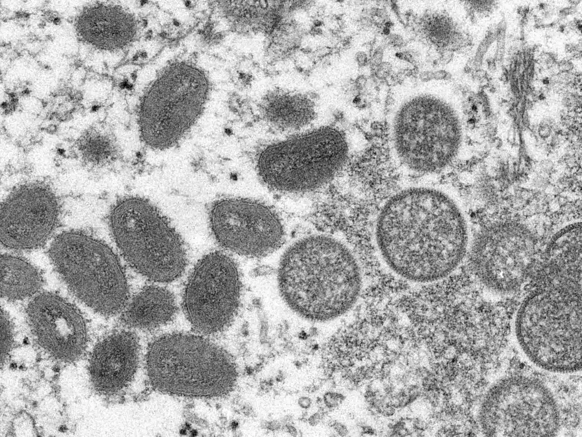 Varíola dos macacos - vírus monkeypox